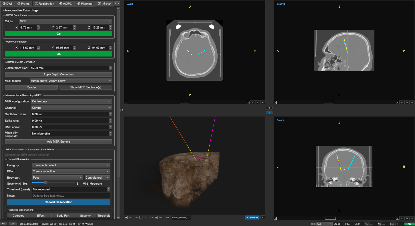 Intraoperative view correlating MER tracks with structural and diffusion imaging
